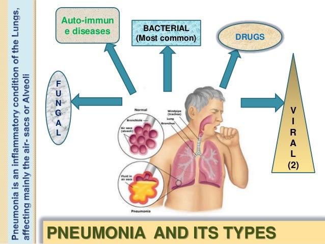 pneumonia virus diagram wiring diagram tutorial Pneumonia Virus Cartoon a case presentation on viral pneumoniaprovisional diagnosis was thought to be viral pneumonia; 4